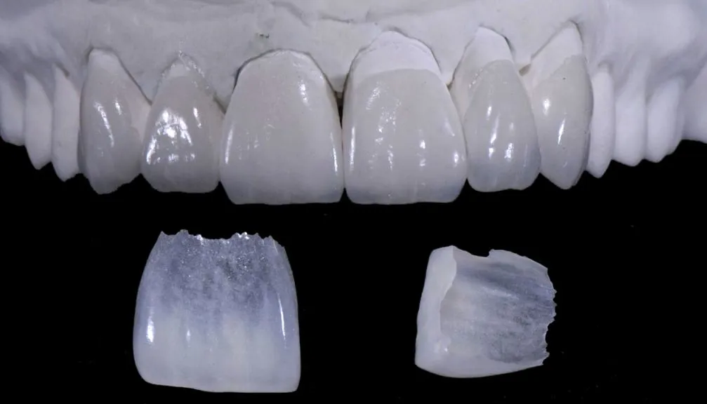 Feldspathic Veneers