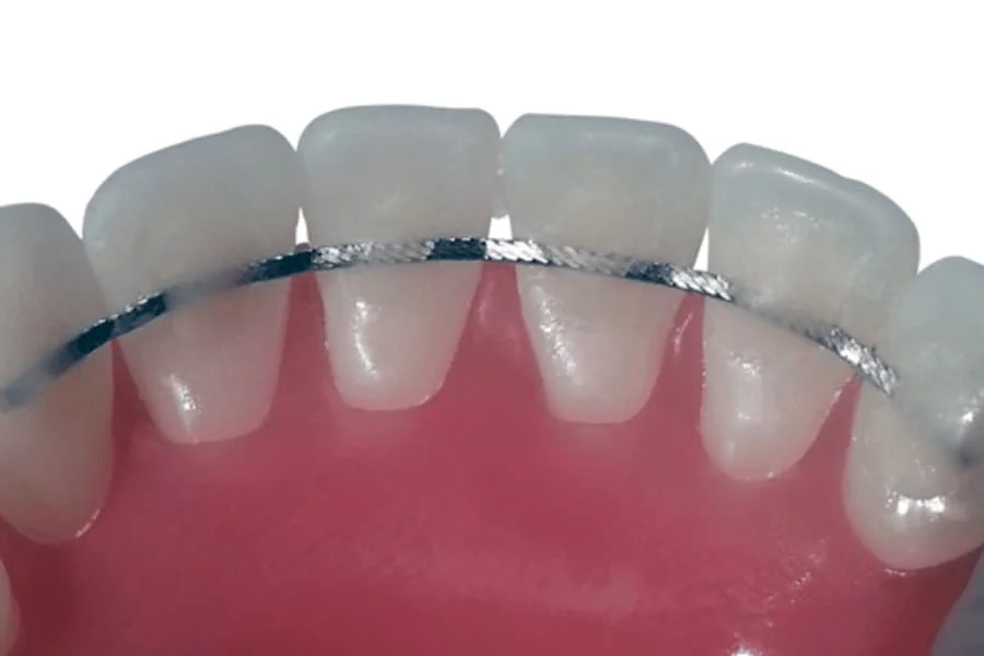 Permanent retainers