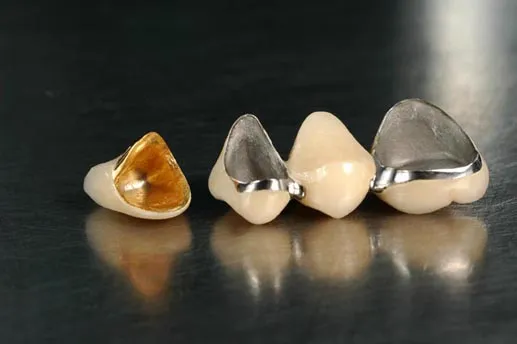 Porcelain Fused Metal Dental Crown