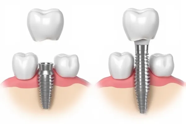 Dental implants replace missing teeth
