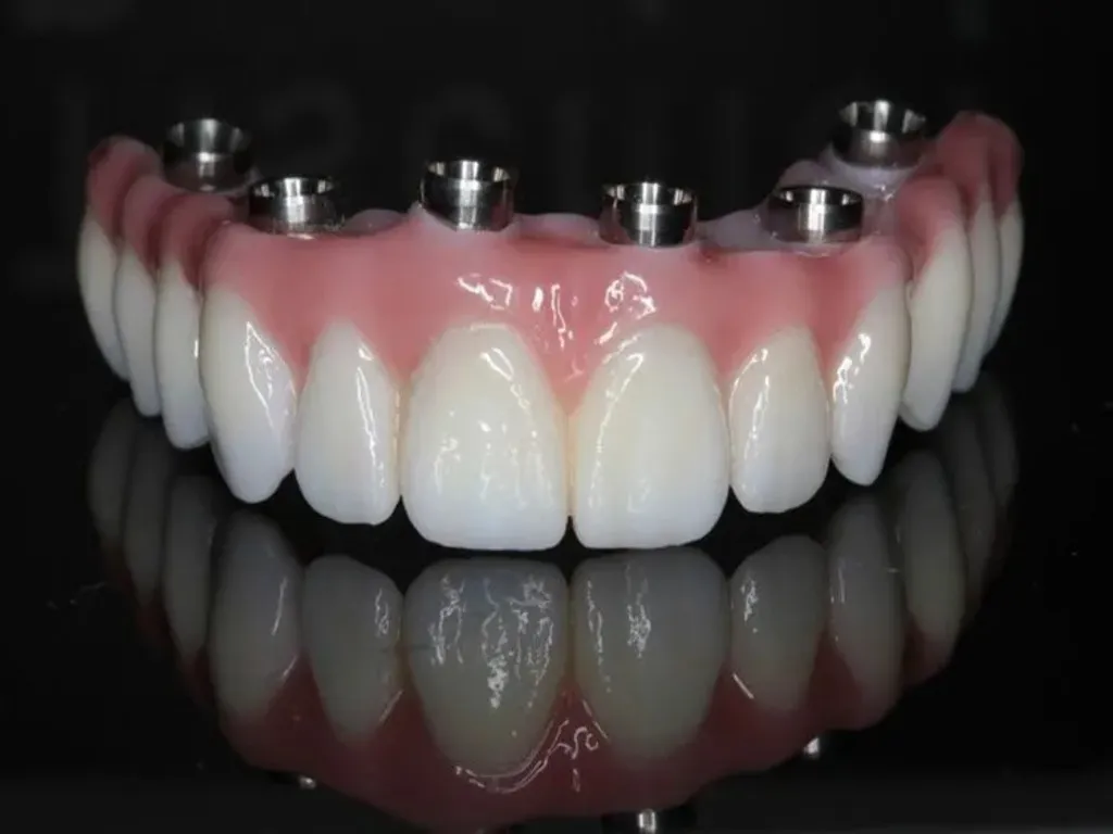 All-Zirconia Screw-Retained Bridge