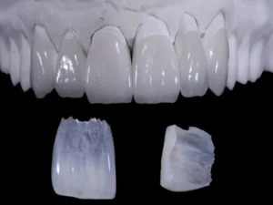 Feldspathic Veneers