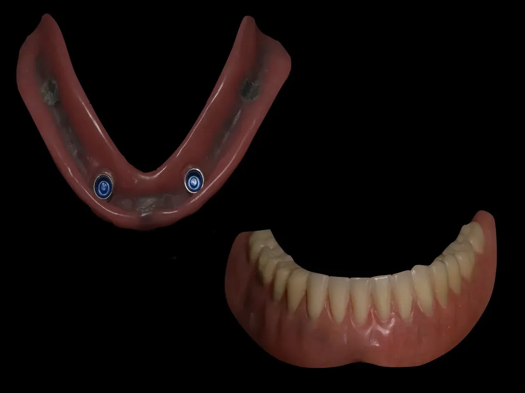 Locator Fixed Dentures