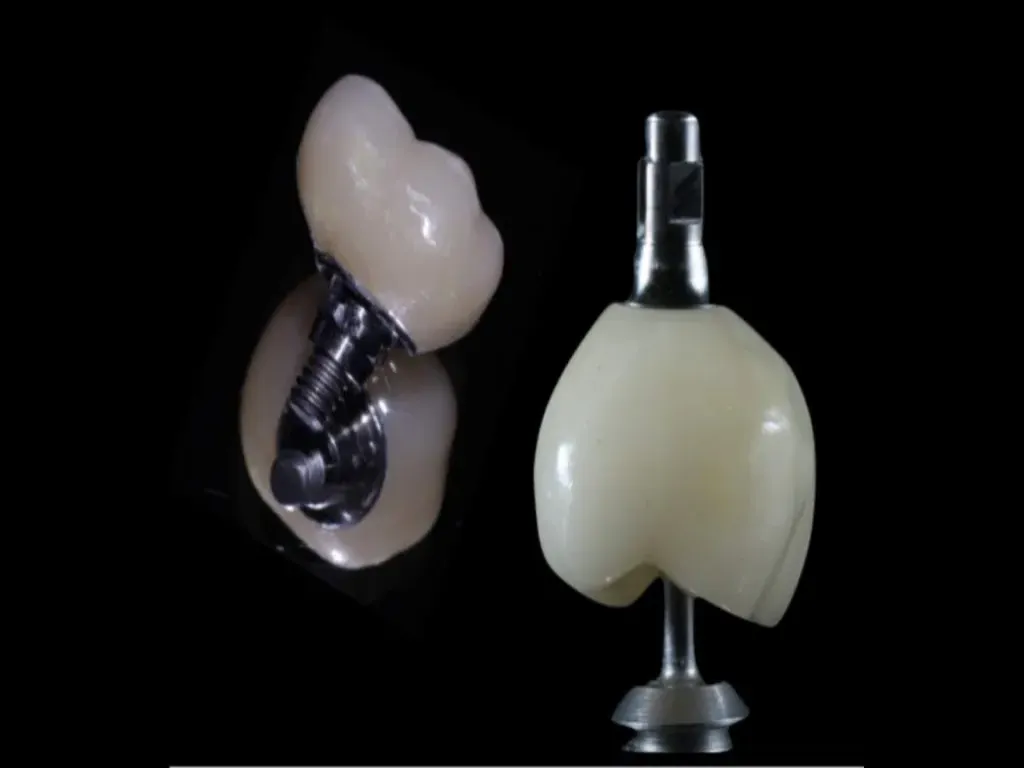 Screw-Retained Implants