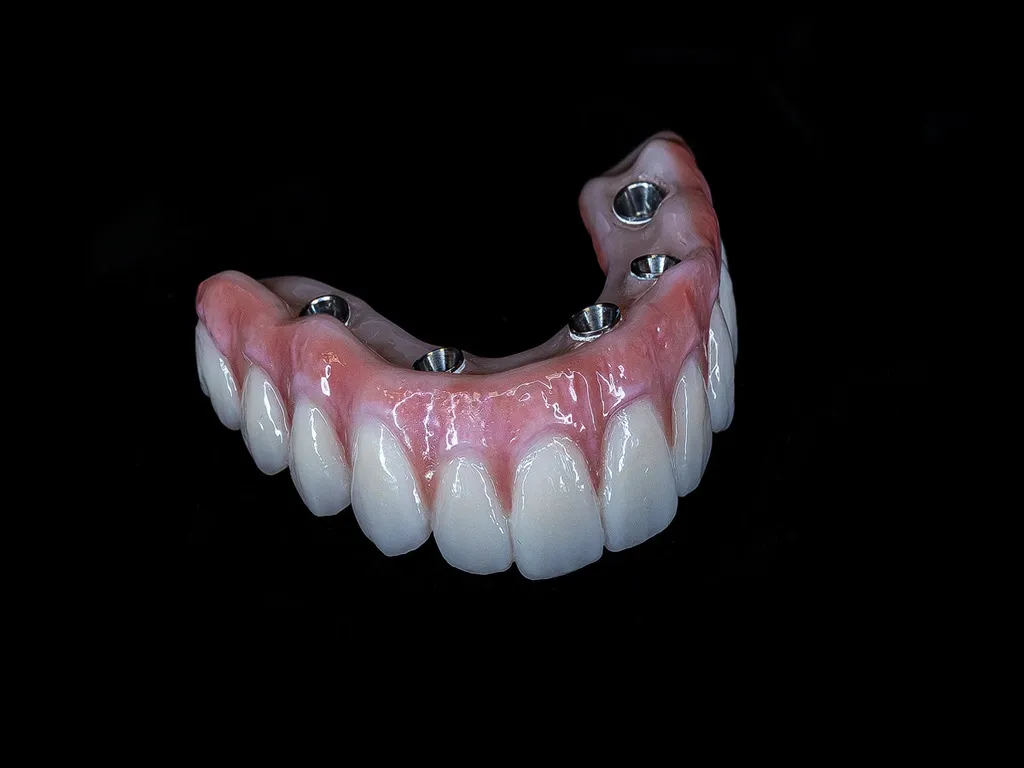 Titanium Hybrid Dentures
