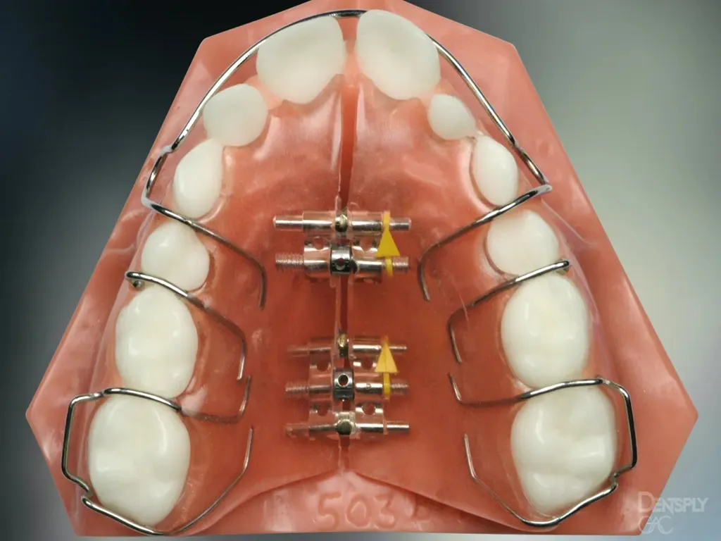 removable palatal expander