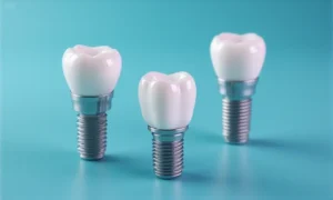How Material Choice Impacts Cost, Quality, and Workflow in Implant Restorations